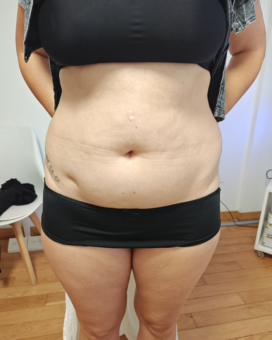Tratamiento abdomen - Después
