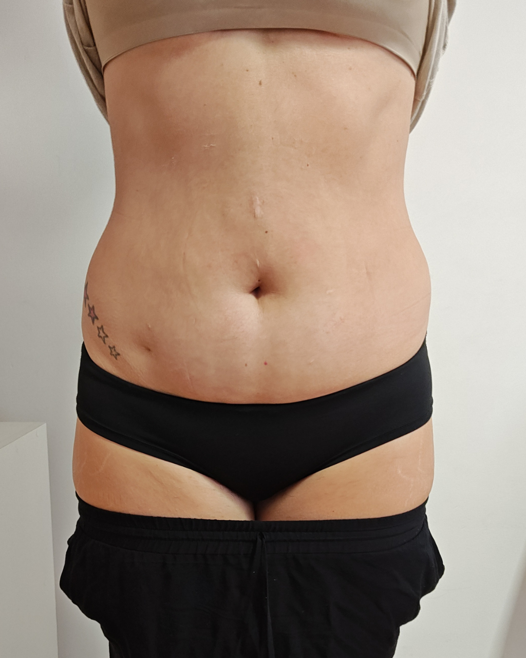 Tratamiento abdomen - Antes