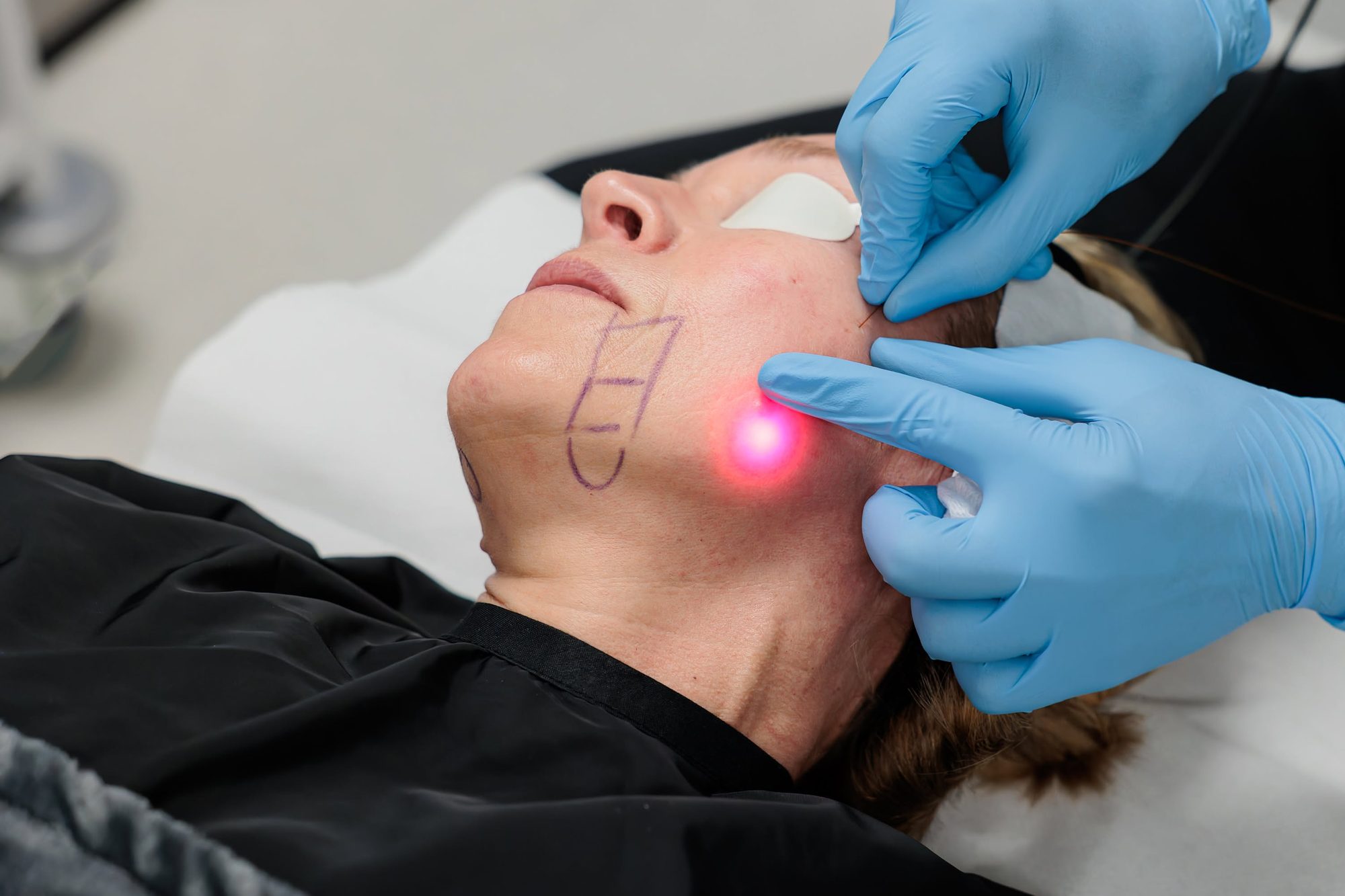 Sesión de Endolift facial con láser subdérmico en Jalaris Aesthetic Point, Miami