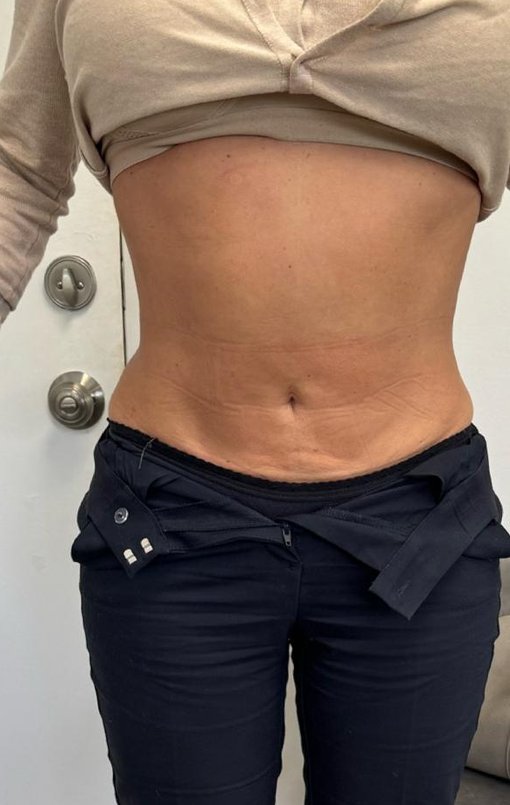 Después HIFU corporal en abdomen, paciente Jalaris Miami