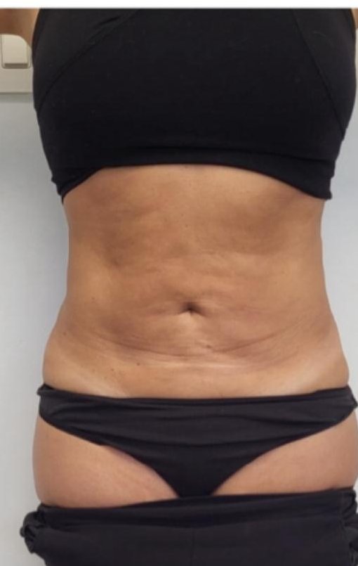 Antes HIFU corporal en abdomen, paciente Jalaris Miami