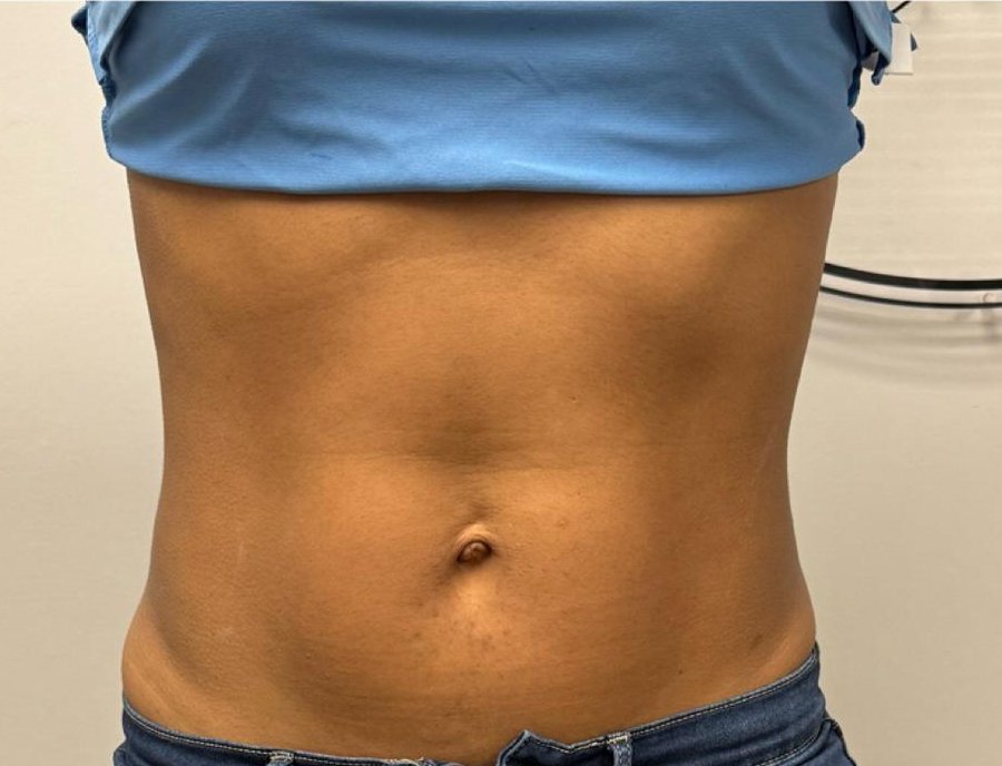 Después HIFU corporal en abdomen, paciente Jalaris Miami