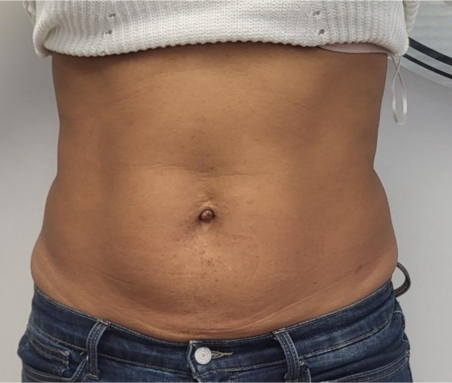 Antes HIFU corporal en abdomen, paciente Jalaris Miami